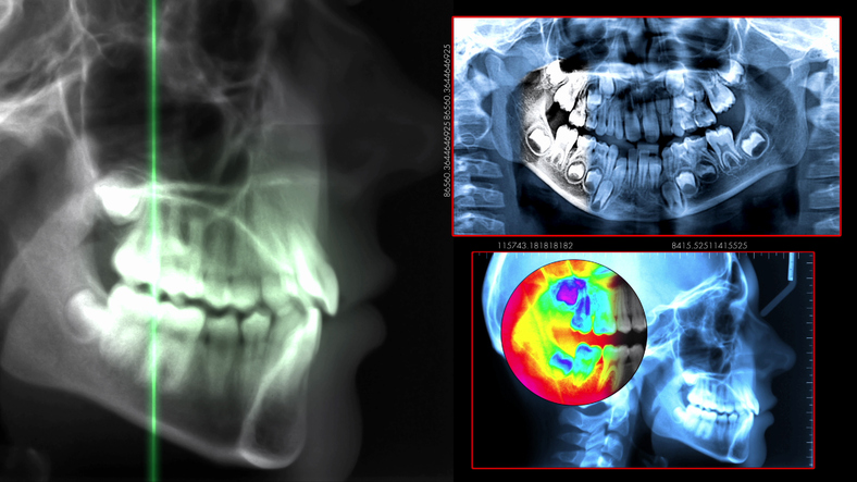 X-rays are used in conjuction with several of our services at Coulter Family Dentistry in Spokane Valley, WA
