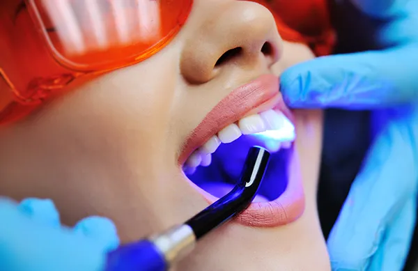 Close up of a dental assistant applying a UV light to a white female patient's newly sealed teeth at Coulter Family Dentistry in Spokane Valley, WA