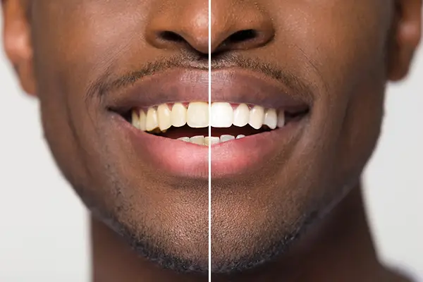 Close up comparison of before and after teeth whitening treatment on a man's smile at Coulter Family Dentistry in Spokane Valley, WA