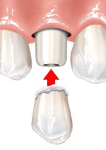 Dental Implant in Gum with Crown