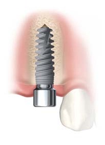 Dental Implant Placement in Bone