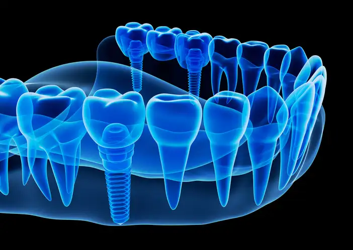 Image representing the Benefits of Dental Implants at Coulter Family Dentistry in Spokane Valley, WA Image representing the Benefits of Dental Implants at Coulter Family Dentistry in Spokane Valley, WA
