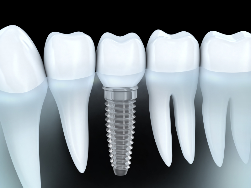 Dental Implants in Spokane Valley, WA