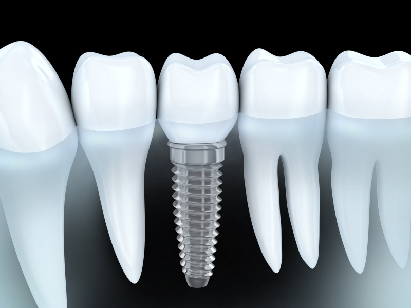 Dental Implants in Spokane Valley, WA Dental Implants in Spokane Valley, WA