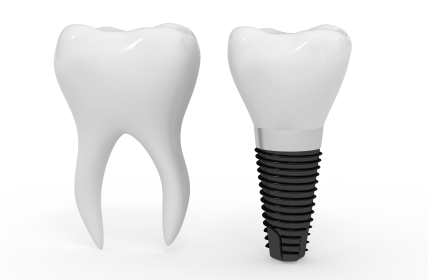 3D rendering of 	<br title='b11'>Dental Implant and Molar Coulter Family Dentistry in Spokane Valley, WA