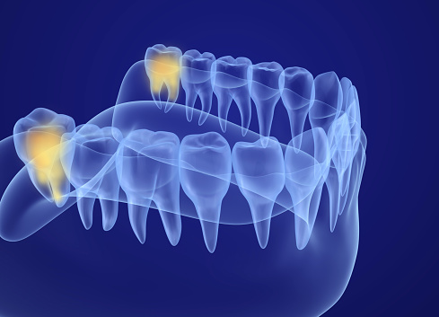 A 3d rendering of where the wisdom teeth are located at Coulter Family Dentistry in Spokane Valley, WA A 3d rendering of where the wisdom teeth are located at Coulter Family Dentistry in Spokane Valley, WA