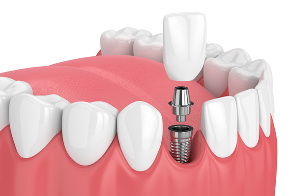 Diagram of a single dental implant from Coulter Family Dentistry in Spokane Valley, WA