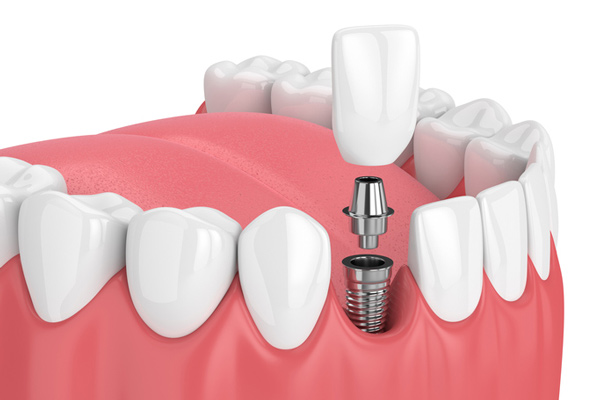 Diagram of a single dental implant from Coulter Family Dentistry in Spokane Valley, WA Diagram of a single dental implant from Coulter Family Dentistry in Spokane Valley, WA