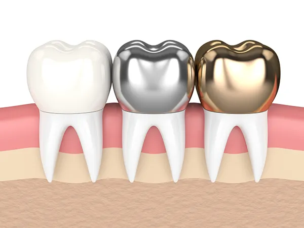 3D rendered cross-section view of three teeth with dental crowns made of different materials at Coulter Family Dentistry in Spokane Valley, WA 3D rendered cross-section view of three teeth with dental crowns made of different materials at Coulter Family Dentistry in Spokane Valley, WA
